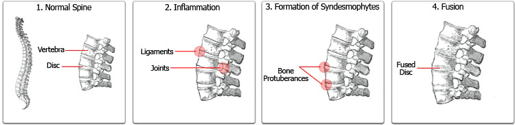 Joint affected with Rheumatoid Arthritis