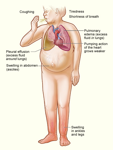 Symptoms of Heart Failure