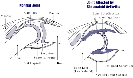 Joint affected with Rheumatoid Arthritis